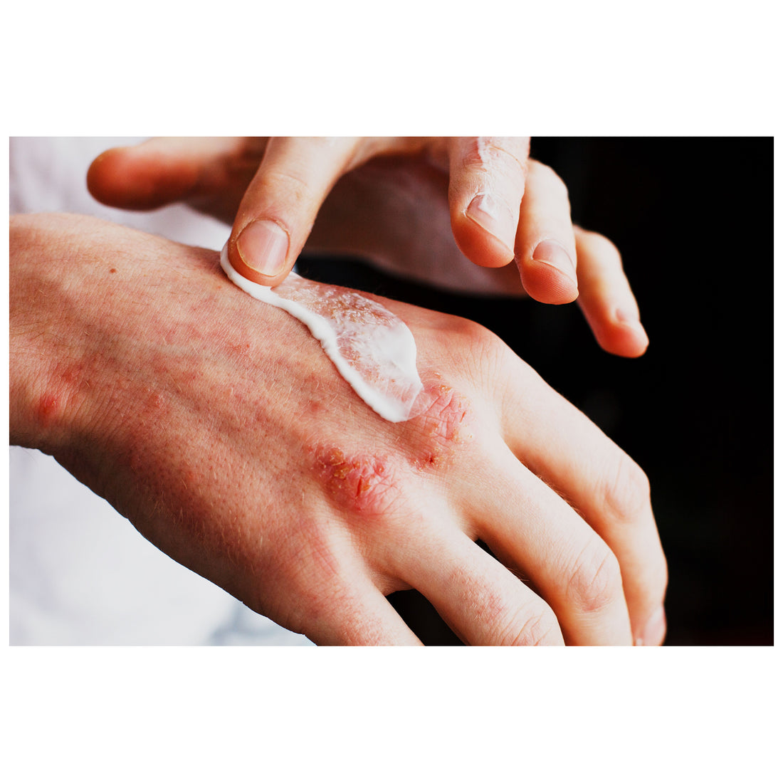 What is the best eczema treatment?